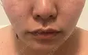 ボトックス（エラ・小顔） / ハイフ（顔） 湘南美容クリニック 大阪心斎橋院 BEFORE サムネイル用