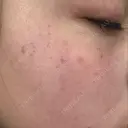 ルメッカ ルラ美容クリニック 静岡院 BEFORE サムネイル用