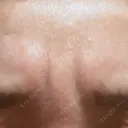 シワ取りボトックス 湘南美容クリニック 新横浜院 BEFORE サムネイル用