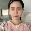 RF（高周波）たるみ治療 Chloe Cheongdam Clinic （クロエチョンダムクリニック） BEFORE サムネイル用