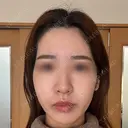 額を丸く / こめかみ形成 / 脂肪注入（額） 湘南美容クリニック 吉祥寺院 BEFORE サムネイル用