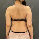 脂肪吸引（二の腕） / 脂肪吸引（背中） オアシス美容外科 BEFORE サムネイル用