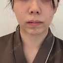 鼻尖形成（切開） / 小鼻縮小（切開） / 軟骨移植 RIVER CLINIC（リバークリニック） BEFORE サムネイル用