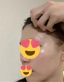 額を丸く / 脂肪注入（肌） / 脂肪注入（額） 湘南美容クリニック 柏院 BEFORE サムネイル用