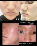 ヴァンパイアフェイシャル 東京美容クリニック 表参道本院 BEFORE サムネイル用