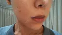 ニキビ治療 The Beauty Clinic SENDAI BEFORE サムネイル用