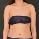 脂肪吸引（二の腕） / 脂肪吸引（背中） Lipo Clinic omotesando BEFORE サムネイル用
