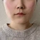 その他（鼻） / ボトックス（あご） / ボトックス（口角） / ボトックス（眉間） / ボトックス（人中） TCB東京中央美容外科 岡山院 BEFORE サムネイル用