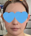 ハイフ（顔） / RF（高周波）たるみ治療 Chloe Cheongdam Clinic （クロエチョンダムクリニック） BEFORE サムネイル用