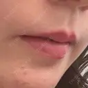 肌ヒアルロン酸注入（たるみ・シワ改善） / ボトックス（口角） / ボトックス（人中） S-Laboクリニック 渋谷院 BEFORE サムネイル用