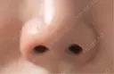 鼻尖形成（切開） / 鼻中隔延長（切開） / 鼻修正 / 鼻尖縮小 / 鼻翼基部形成（貴族手術） / 鼻柱下降・鼻唇角形成（猫手術） KIMI CLINIC 形成・美容外科 BEFORE サムネイル用