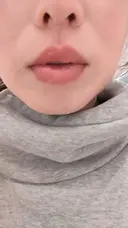 肌ヒアルロン酸注入（たるみ・シワ改善） HAAB×DREAM BEAUTY CLINIC 大阪梅田院 BEFORE サムネイル用