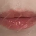 ヒアルロン酸注入（唇） / ヒアルロン酸注入（目の下） KIMI CLINIC 形成・美容外科 BEFORE サムネイル用