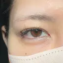 二重埋没 / 目頭切開 アリエル美容クリニック 大宮院 BEFORE サムネイル用