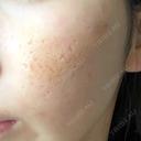 ポテンツァ CZEN CLINIC 銀座院 BEFORE サムネイル用