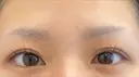 二重埋没 / 自然癒着法 eクリニック 岡山院 BEFORE サムネイル用