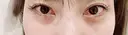 ヒアルロン酸注入（涙袋） ネビュラクリニック 東京錦糸町院 BEFORE サムネイル用