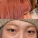 クマ治療 / ヒアルロン酸注入（目の下） PRISM Beauty Clinic 町田院 BEFORE サムネイル用