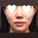 マイクロボトックス / その他（肌） シェリークリニック 福岡院 BEFORE サムネイル用