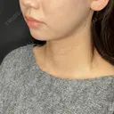 糸リフト / 脂肪吸引（顔） THE FIRST CLINIC 多摩センター院 BEFORE サムネイル用