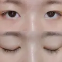 二重埋没 / 眼瞼下垂（切開） アリナガ美容外科 BEFORE サムネイル用