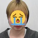 ボトックス（エラ・小顔） / 脂肪溶解注射（顔） / ボトックス（肩） TCB東京中央美容外科 長野院 BEFORE サムネイル用