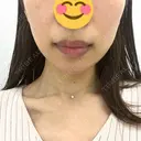 RF（高周波）たるみ治療 TUNE CLINIC【チューンクリニック】 BEFORE サムネイル用