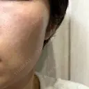 イオン導入 / ピーリング（ハリ・ツヤ） / ルメッカ ルラ美容クリニック 名古屋栄院 / ルラスキンクリニック 名古屋栄院 BEFORE サムネイル用