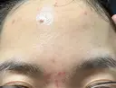 ニキビ治療 オラクル美容皮膚科 札幌院 BEFORE サムネイル用