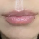 ヒアルロン酸注入（唇） アネシス美容クリニック BEFORE サムネイル用