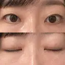 二重埋没 水の森美容クリニック 横浜院 BEFORE サムネイル用