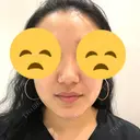 鼻尖形成（切開） / 鼻中隔延長（切開） / その他（鼻） / 軟骨移植 / ボトックス（あご） / ヒアルロン酸注入（あご） / ボトックス（エラ・小顔） / ボトックス（肩） エートップ美容整形外科 BEFORE サムネイル用