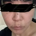 鼻尖形成（切開） / 小鼻縮小（切開） / 軟骨移植 ASTRA BEAUTY CLINIC BEFORE サムネイル用