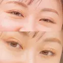 眼瞼下垂（非切開） SOL CLINIC BEFORE サムネイル用