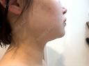 その他（輪郭） さっぽろ美容クリニック BEFORE サムネイル用