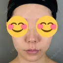 鼻尖形成（切開） / 人中短縮 / 鼻孔縁挙上 / その他（鼻） アリエル美容クリニック 大宮院 BEFORE サムネイル用