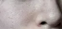 毛穴洗浄（ハイドラフェイシャルなど） / ピコフラクショナルレーザー（毛穴・ニキビ跡） 心斎橋KT美容クリニック BEFORE サムネイル用