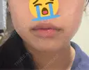 ボトックス（あご） / ボトックス（エラ・小顔） / ボトックス（口角） / ボトックス（額） / ボトックス（人中） / ボトックス（ガミースマイル） BiBiクリニック BEFORE サムネイル用
