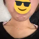 ボトックス（あご） フォンタナクリニック天神 BEFORE サムネイル用