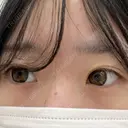 二重切開 / 目頭切開 / 眼瞼下垂（切開） / ヒアルロン酸注入（涙袋） 東京シンデレラ美容外科 池袋院 BEFORE サムネイル用