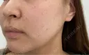 ボトックス（肩） / ピーリング（ハリ・ツヤ） ギャラリークリニック 横浜院 BEFORE サムネイル用