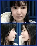 鼻修正 / 切開リフト / 鼻翼基部形成（貴族手術） リッツ美容外科 東京院 BEFORE サムネイル用