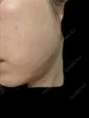 ルビーレーザー AZ BEAUTY CLINIC BEFORE サムネイル用