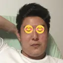 ほくろ・いぼ切除（肌） 吉田美容形成クリニック BEFORE サムネイル用