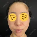 ヒアルロン酸注入（あご） / ヒアルロン酸注入（額） / ヒアルロン酸注入（鼻翼基部） 藤・ナチュレ美容クリニック 銀座院 BEFORE サムネイル用