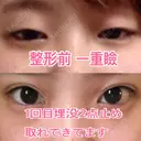二重埋没 恵聖会クリニック 心斎橋院 BEFORE サムネイル用