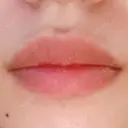 ヒアルロン酸注入（唇） TCB東京中央美容外科 堺院 BEFORE サムネイル用