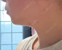 RF（高周波）たるみ治療 CIEL SKIN CLINIC（シエルスキンクリニック） BEFORE サムネイル用