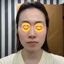 肌ヒアルロン酸注入（たるみ・シワ改善） / ヒアルロン酸注入（あご） / ボトックス（エラ・小顔） / ヒアルロン酸注入（唇） / ボトックス（額） HAAB×DREAM BEAUTY CLINIC 大阪梅田院 BEFORE サムネイル用