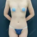 豊胸（脂肪注入） 湘南美容クリニック 吉祥寺院 BEFORE サムネイル用